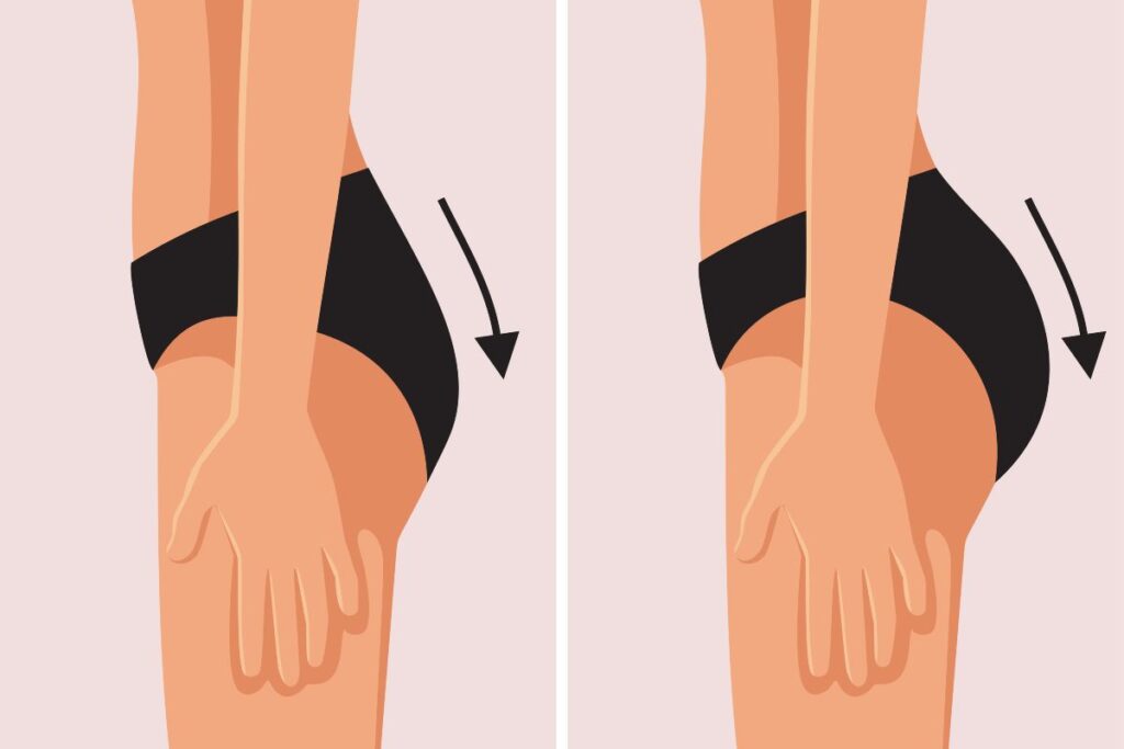 Before and after illustration showing buttock augmentation surgery results.