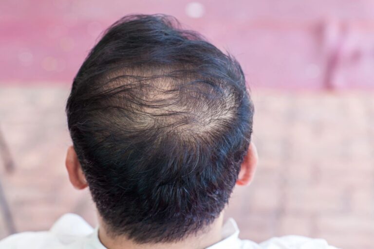 Thinning hair with visible scalp at the crown.