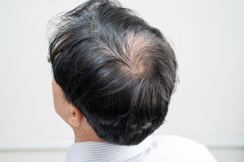 Thinning hair at the crown with visible scalp and existing hair.